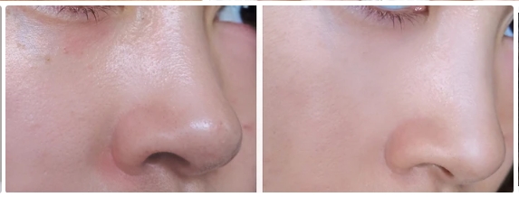Before and after applying RG Calming Care Modelling Pack showing skin improvement